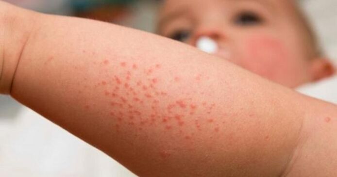 Hautausschlag als Symptom einer parasitären Infektion