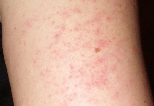 Juckende Hautausschläge sind ein Symptom für das Vorhandensein von Würmern in der Leber