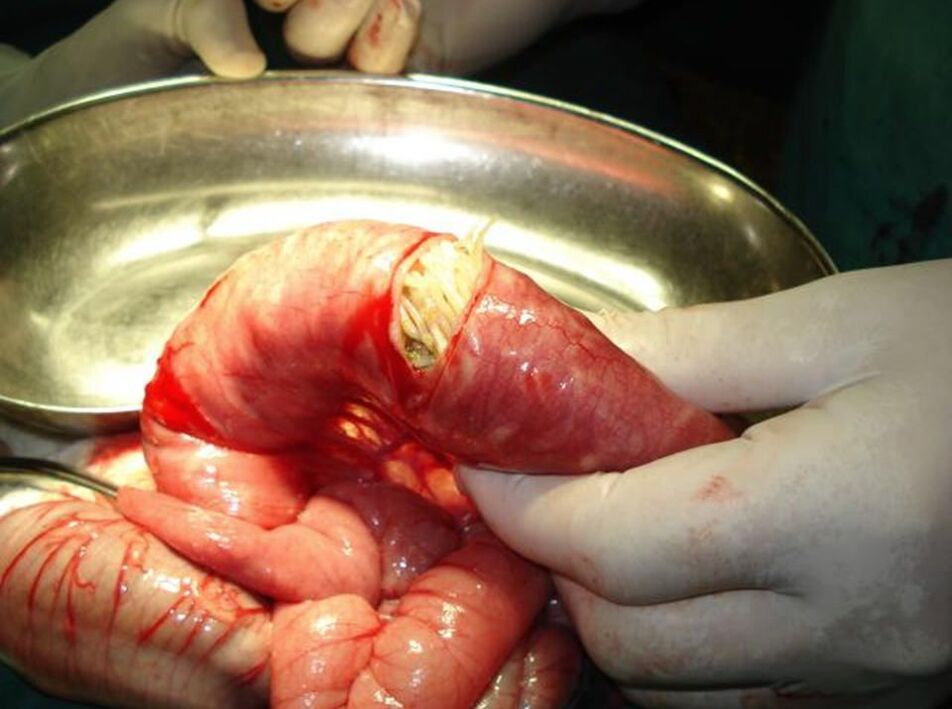 Nematoden im menschlichen Darm